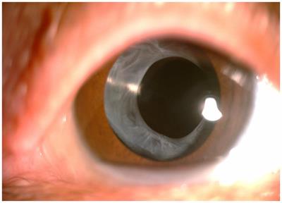 Exploring anterion capsular contraction syndrome in cataract surgery: insights into pathogenesis, clinical course, influencing factors, and intervention approaches